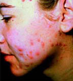 treatingacne | topacnetreatments